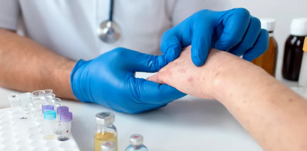 tangan dengan ruam-ruam merah dipegang oleh sepasang tangan bersarung tangan biru.