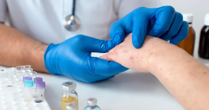 tangan dengan ruam-ruam merah dipegang oleh sepasang tangan bersarung tangan biru.